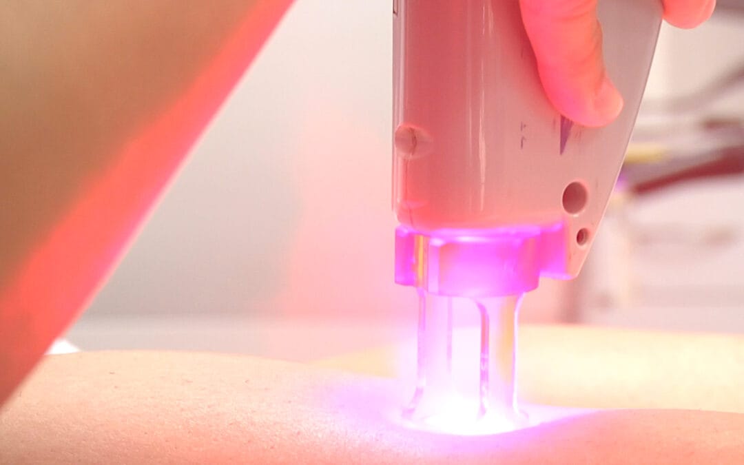 Light-based laser hair removal treatment on a person's legs