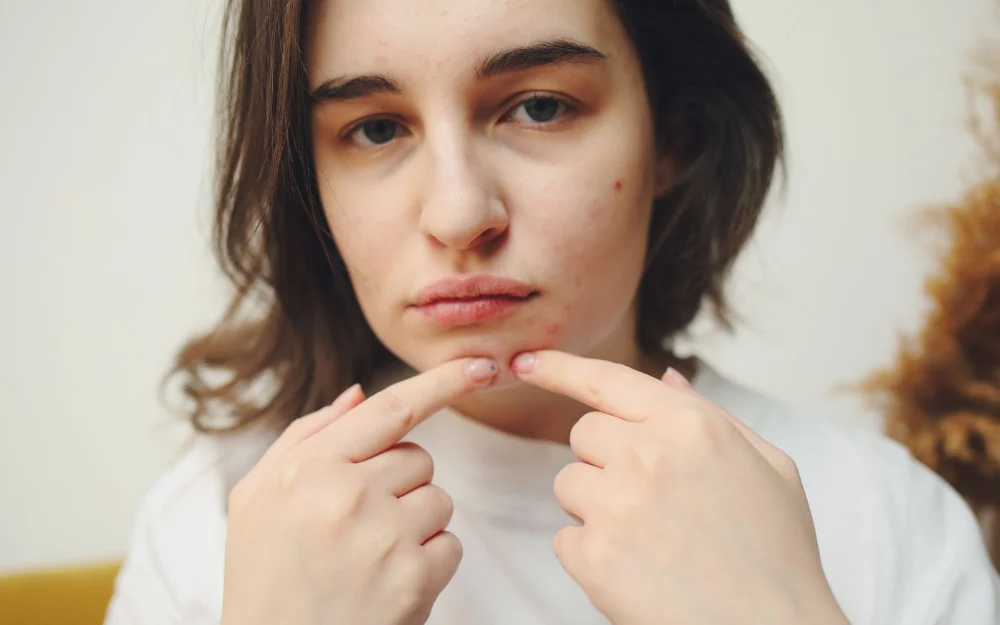 Best pimple patches UK 2026: 6 spot patches worth buying